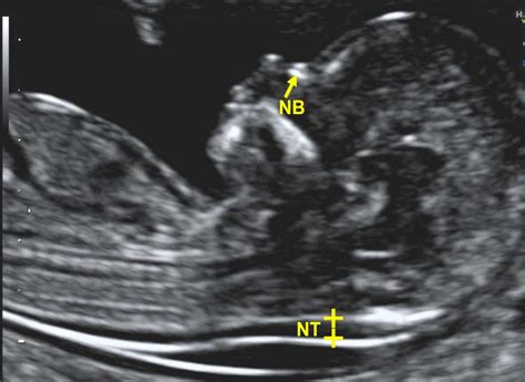 nuchal translucency ultrasound images